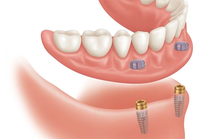 Young Dentures Before 
      And After Bandy VA 24602